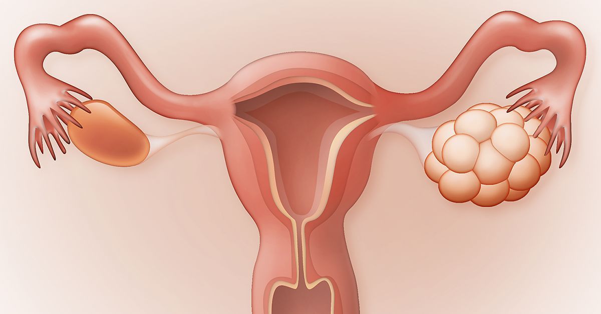 5 Natural Supplements to Treat PCOS Symptoms